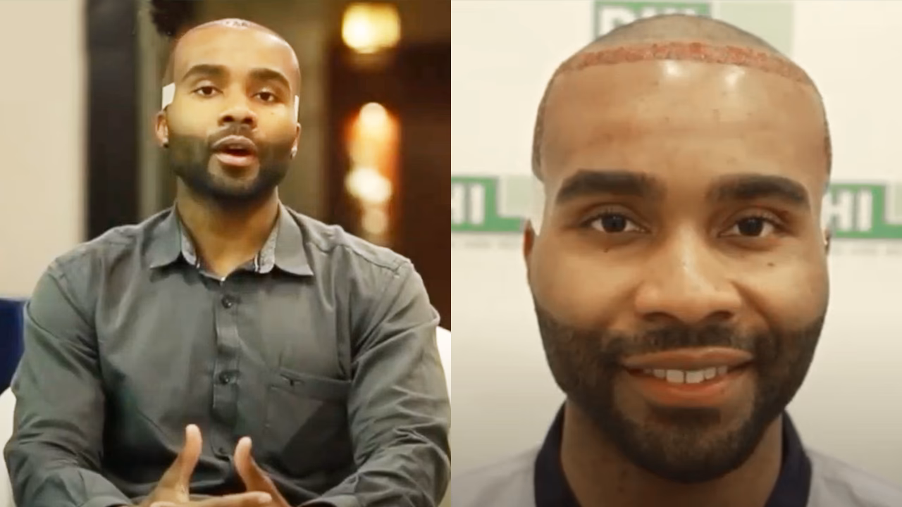 ¿Cuánto cubren 3000 folículos?