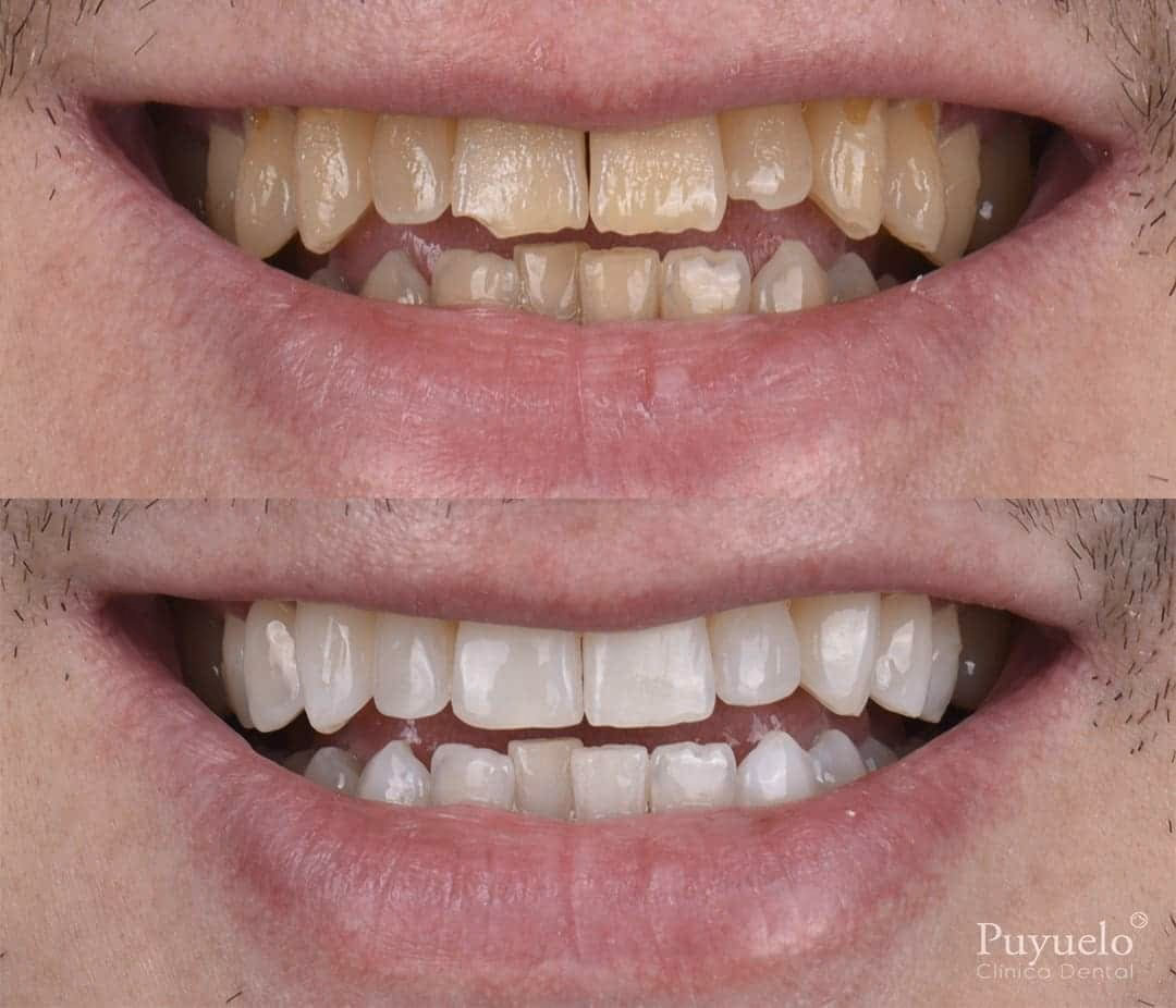 ¿Cómo restaurar el esmalte dental de forma natural?