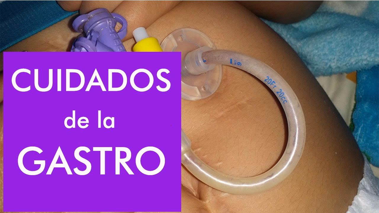 ¿Cuáles son los cuidados de enfermería para una gastrostomía?