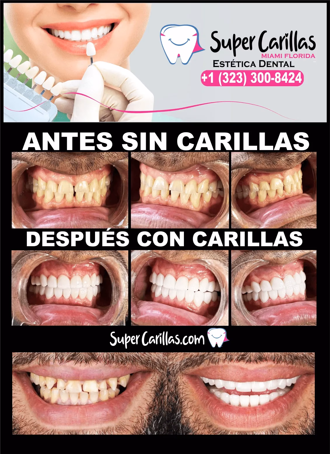 ¿Cuánto cuesta una resina dental en Estados Unidos?