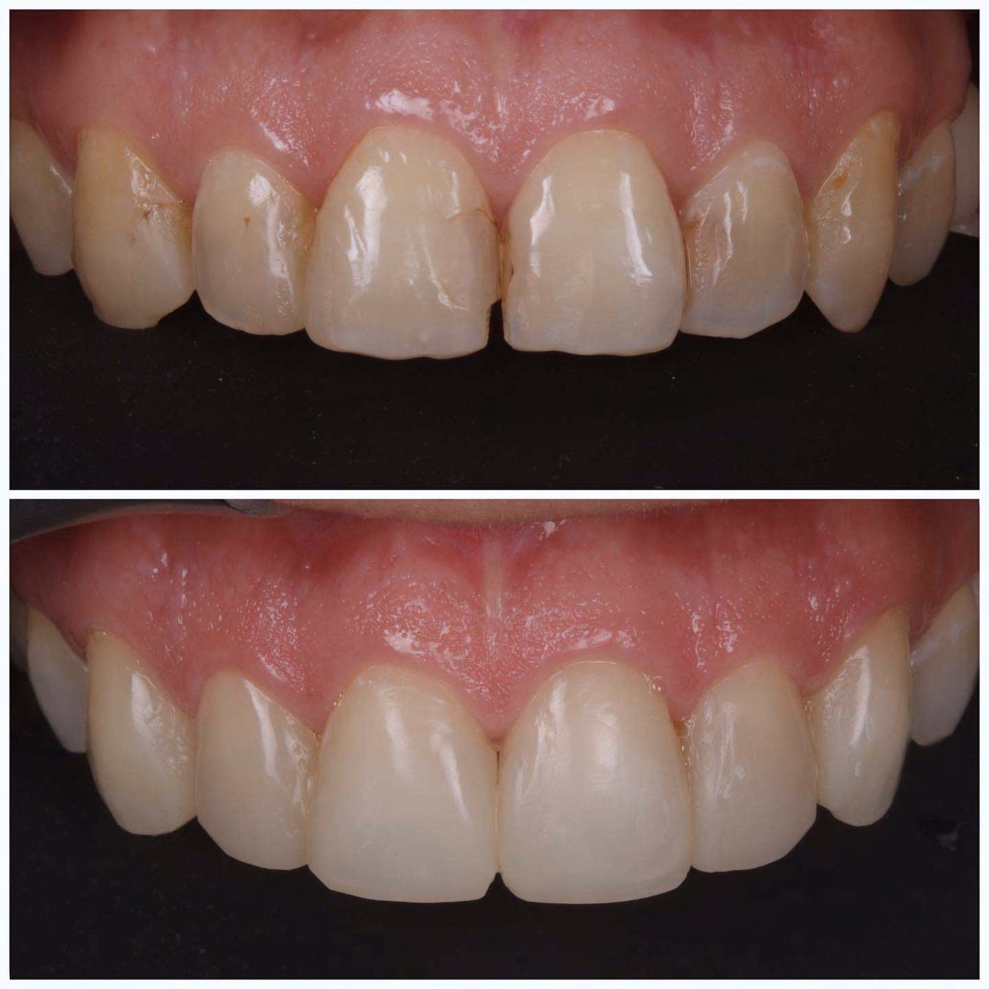 ¿Cuánto duran las restauraciones dentales?