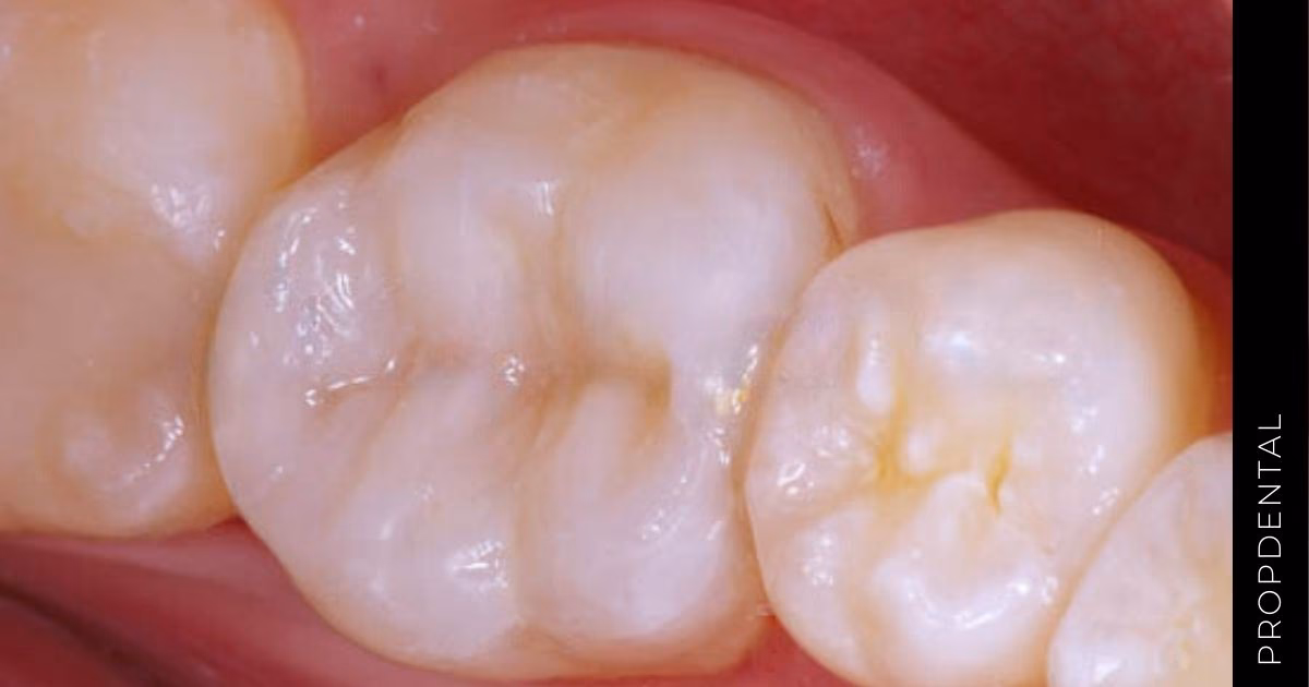 ¿Cuánto vale la restauración de un diente?