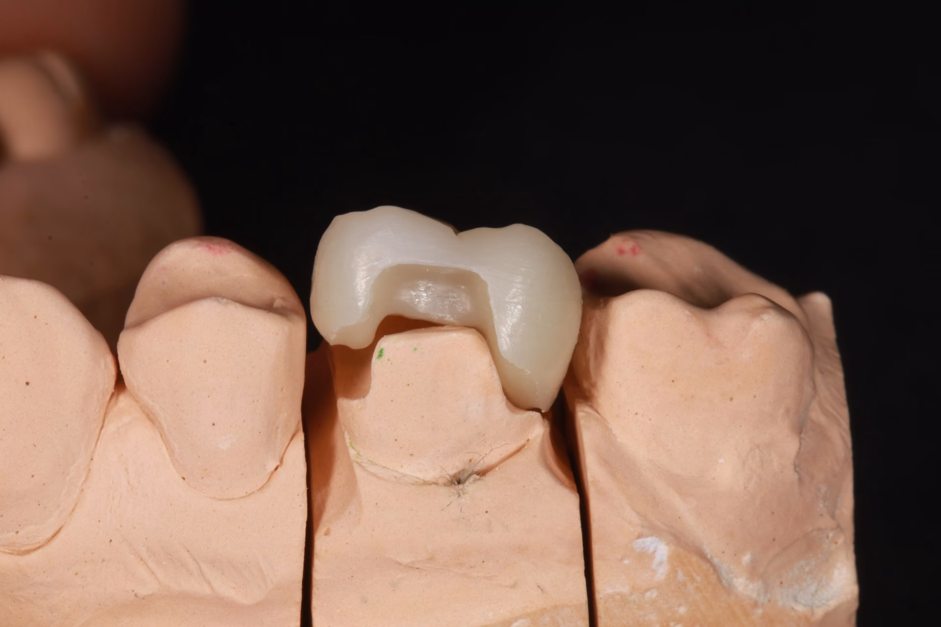 ¿Qué es la técnica de onlay?